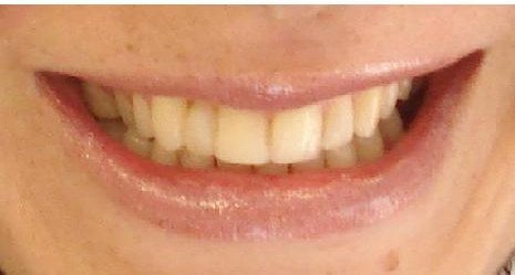 After dental alignment treatment reference image