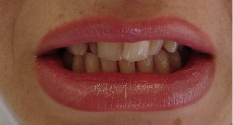 Before dental alignment treatment reference image